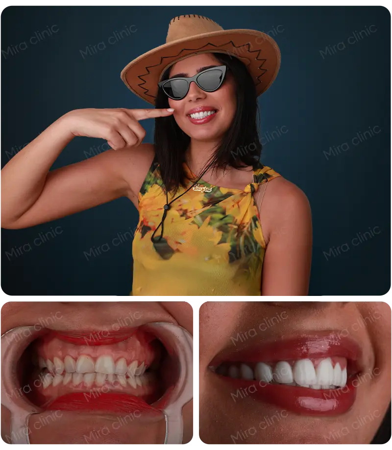 Hollywood smile before after